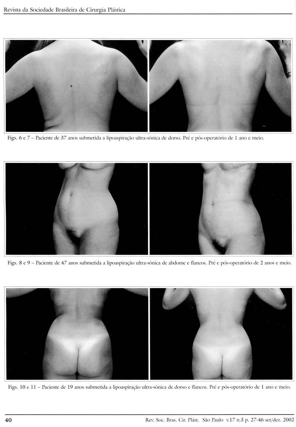 8 e 9 - Paciente de 47 anos submetida a Lipoaspiraçãoultra-sônica de abdome e flancos. Pré e pós-operatório de 2 anos e meio.