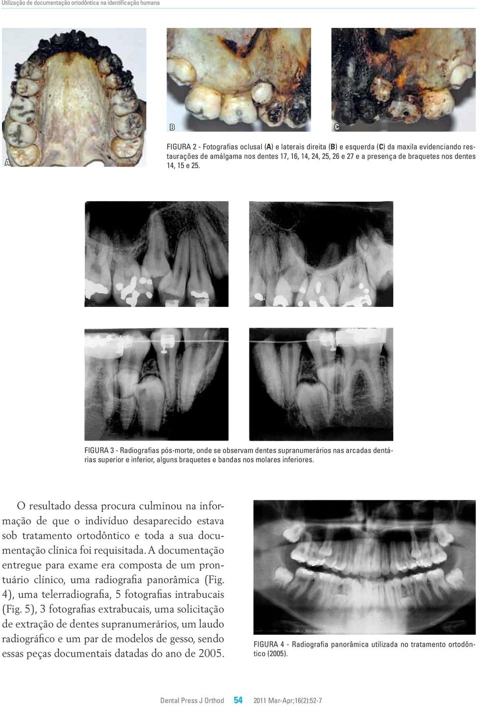 Figura 3 - Radiografias pós-morte, onde se observam dentes supranumerários nas arcadas dentárias superior e inferior, alguns braquetes e bandas nos molares inferiores.