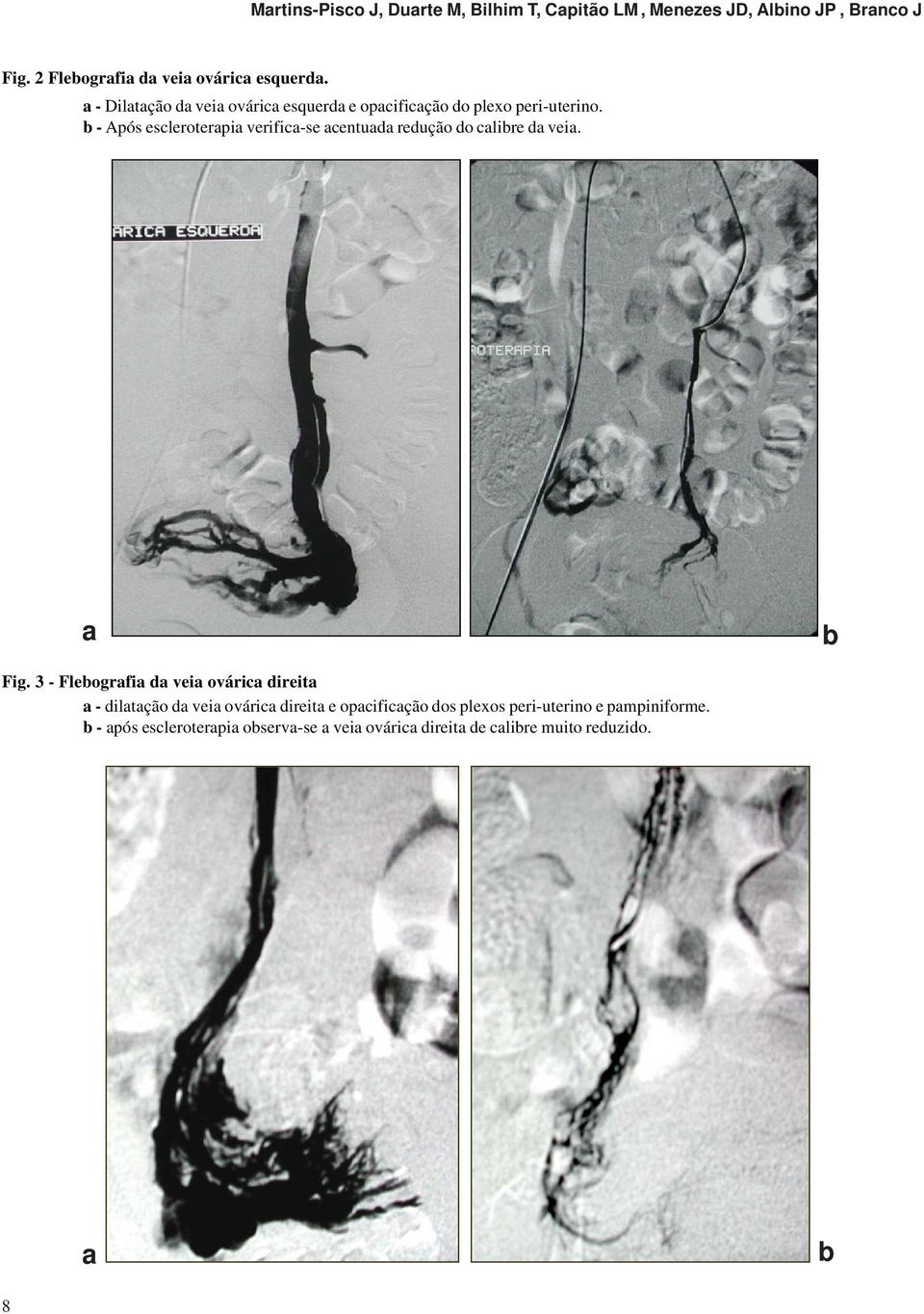 b - Após escleroterapia verifica-se acentuada redução do calibre da veia. a b Fig.