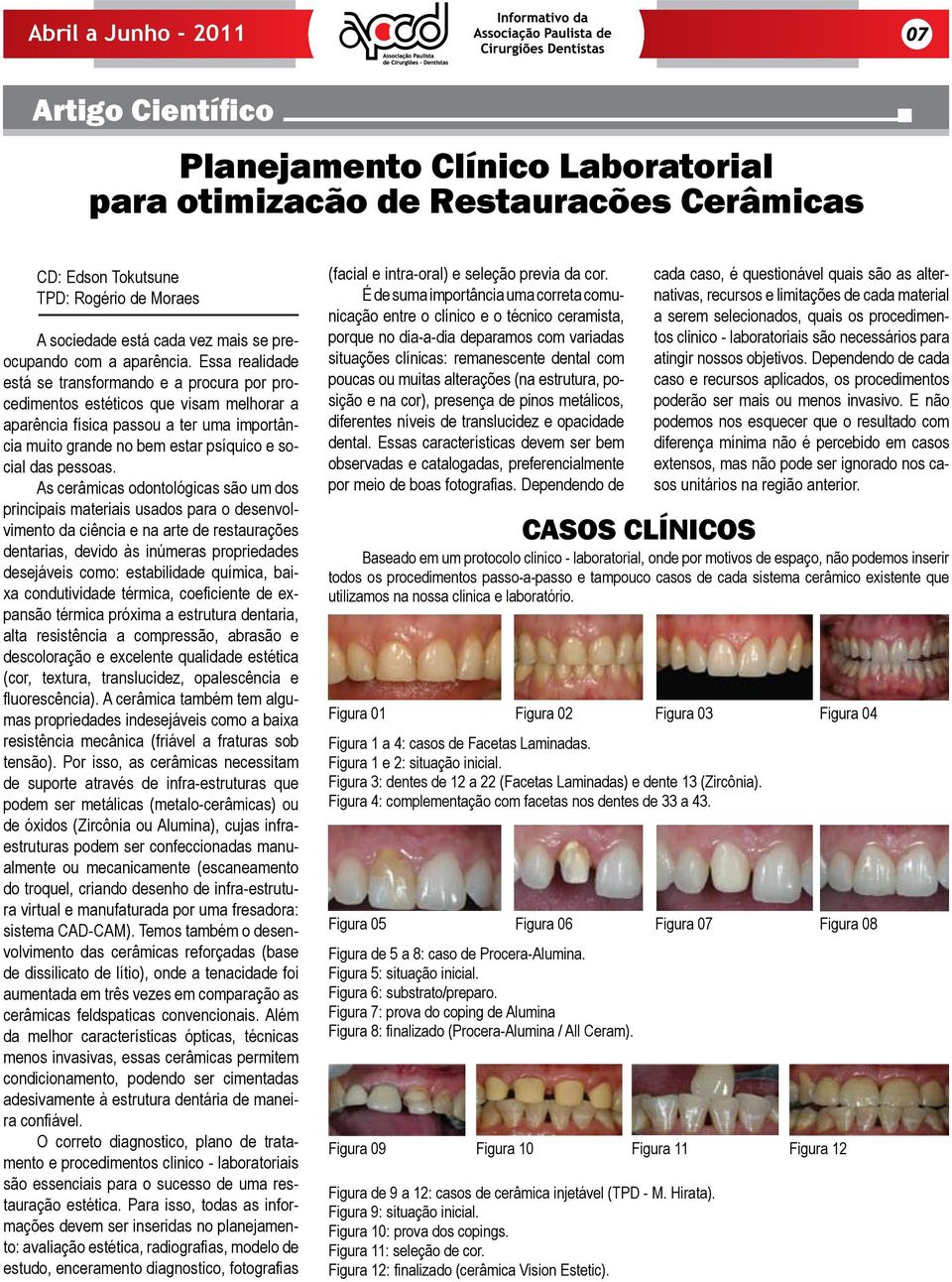 As cerâmicas odontológicas são um dos principais materiais usados para o desenvolvimento da ciência e na arte de restaurações dentarias, devido às inúmeras propriedades desejáveis como: estabilidade