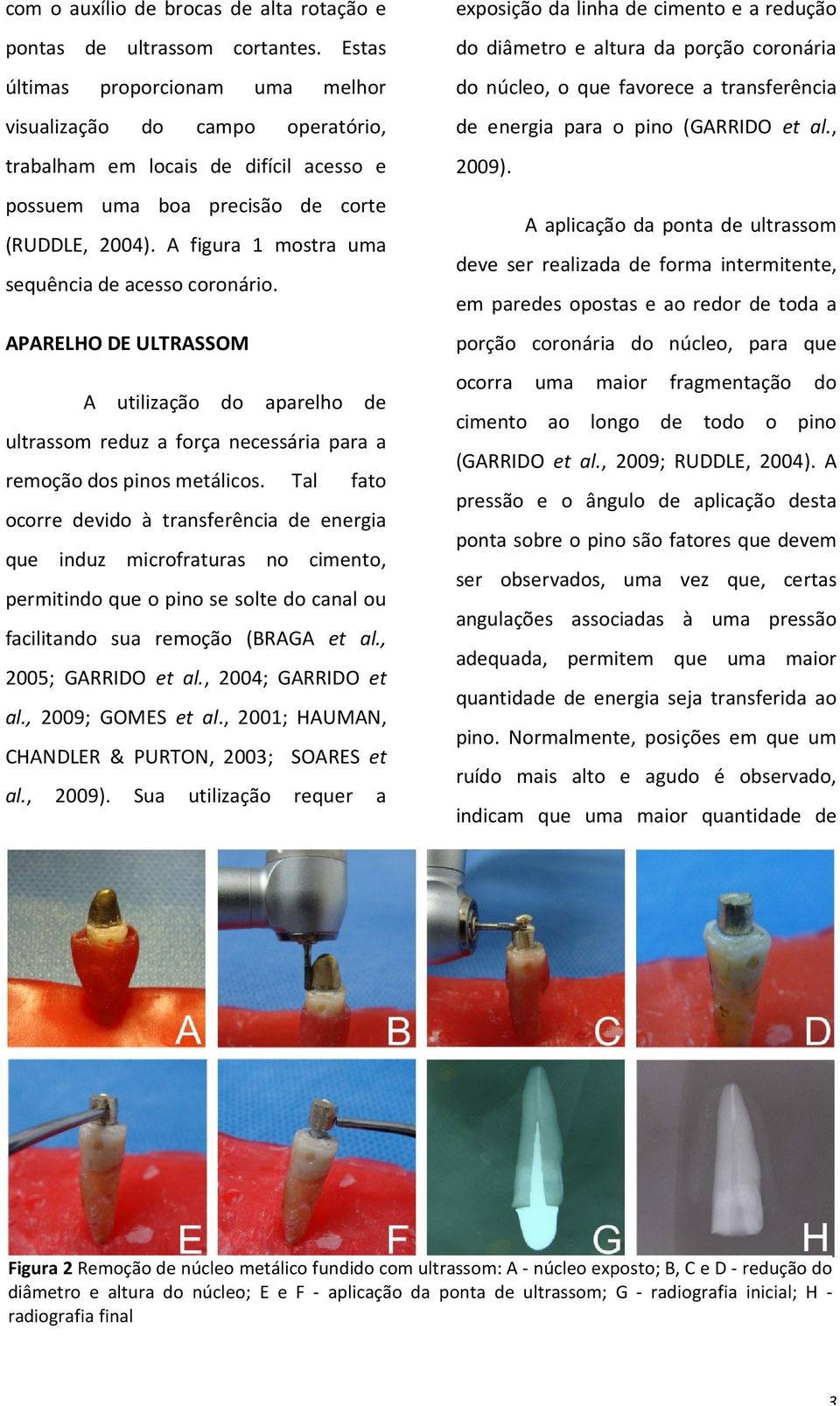 A figura 1 mostra uma sequência de acesso coronário. APARELHO DE ULTRASSOM A utilização do aparelho de ultrassom reduz a força necessária para a remoção dos pinos metálicos.