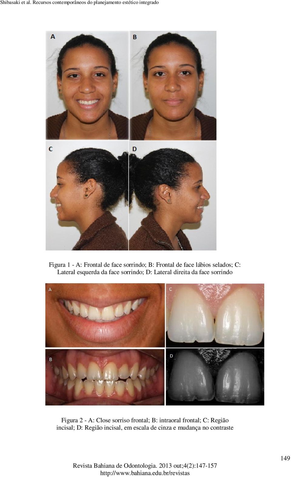 face sorrindo Figura 2 - A: Close sorriso frontal; B: intraoral frontal;