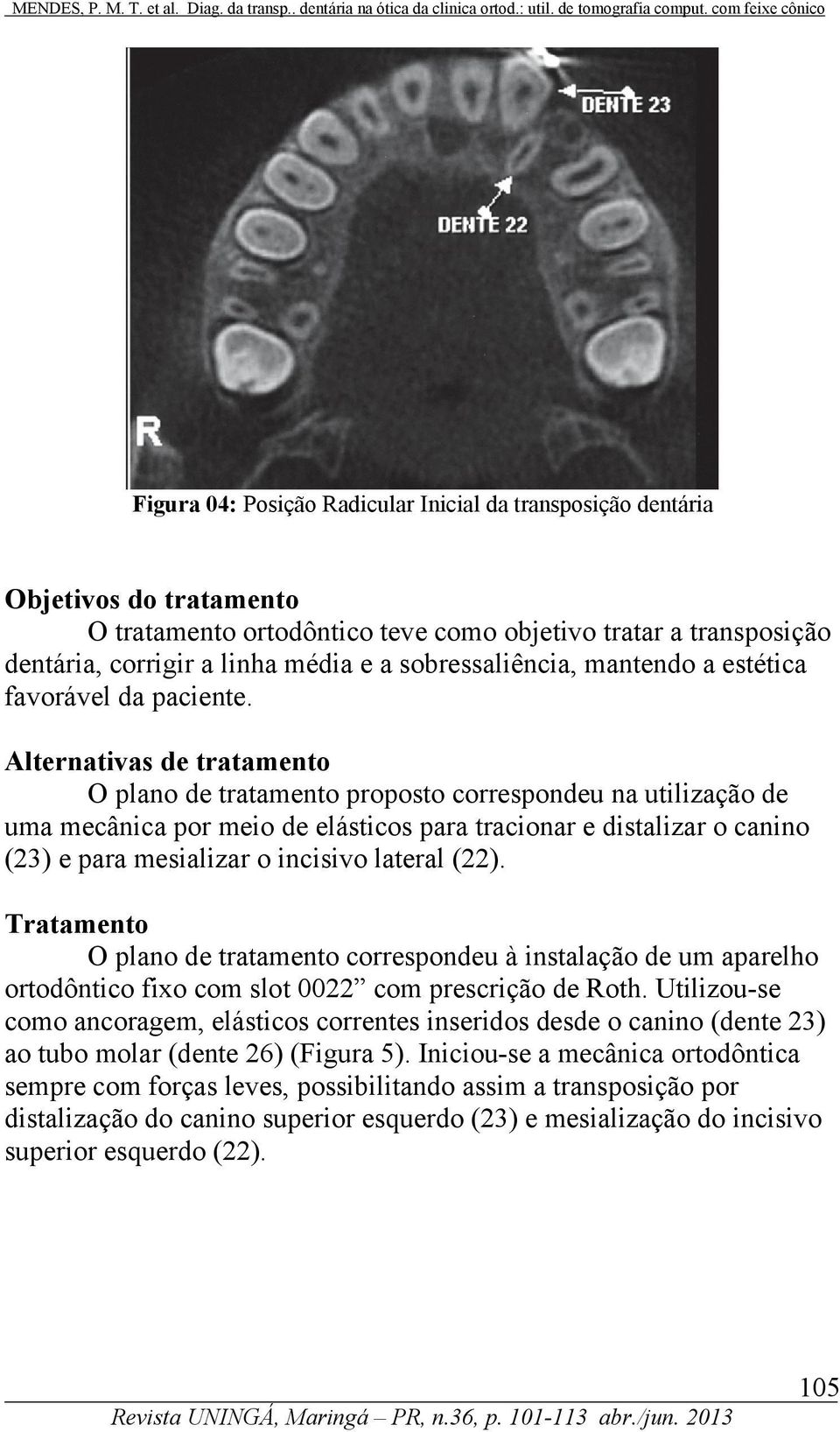 Alternativas de tratamento O plano de tratamento proposto correspondeu na utilização de uma mecânica por meio de elásticos para tracionar e distalizar o canino (23) e para mesializar o incisivo