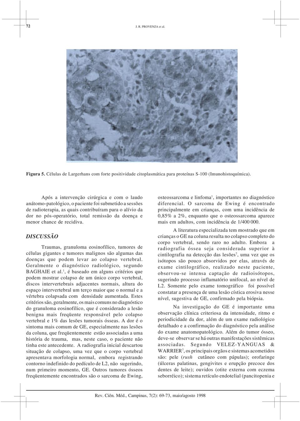 doença e menor chance de recidiva. DISCUSSÃO Traumas, granuloma eosinofílico, tumores de células gigantes e tumores malignos são algumas das doenças que podem levar ao colapso vertebral.