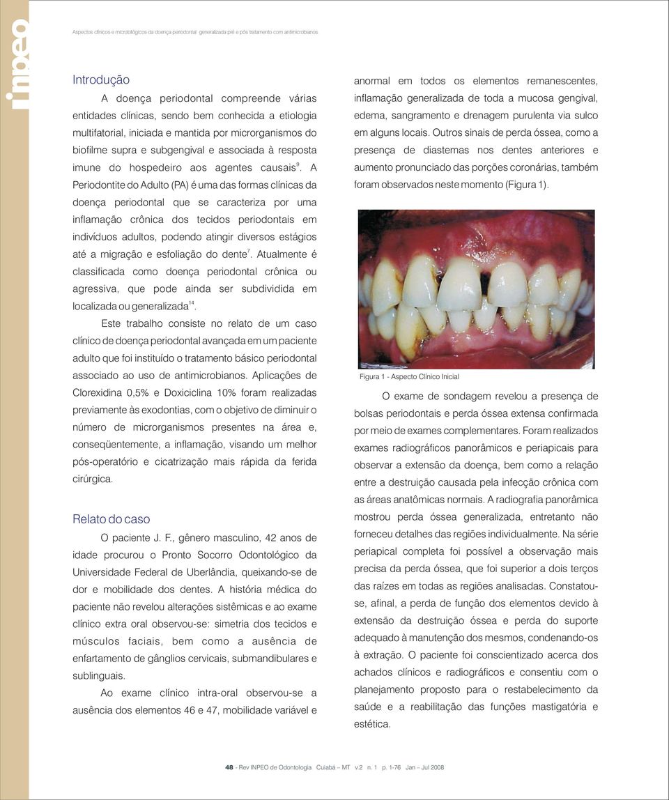 A Periodontite do Adulto (PA) é uma das formas clínicas da doença periodontal que se caracteriza por uma inflamação crônica dos tecidos periodontais em indivíduos adultos, podendo atingir diversos