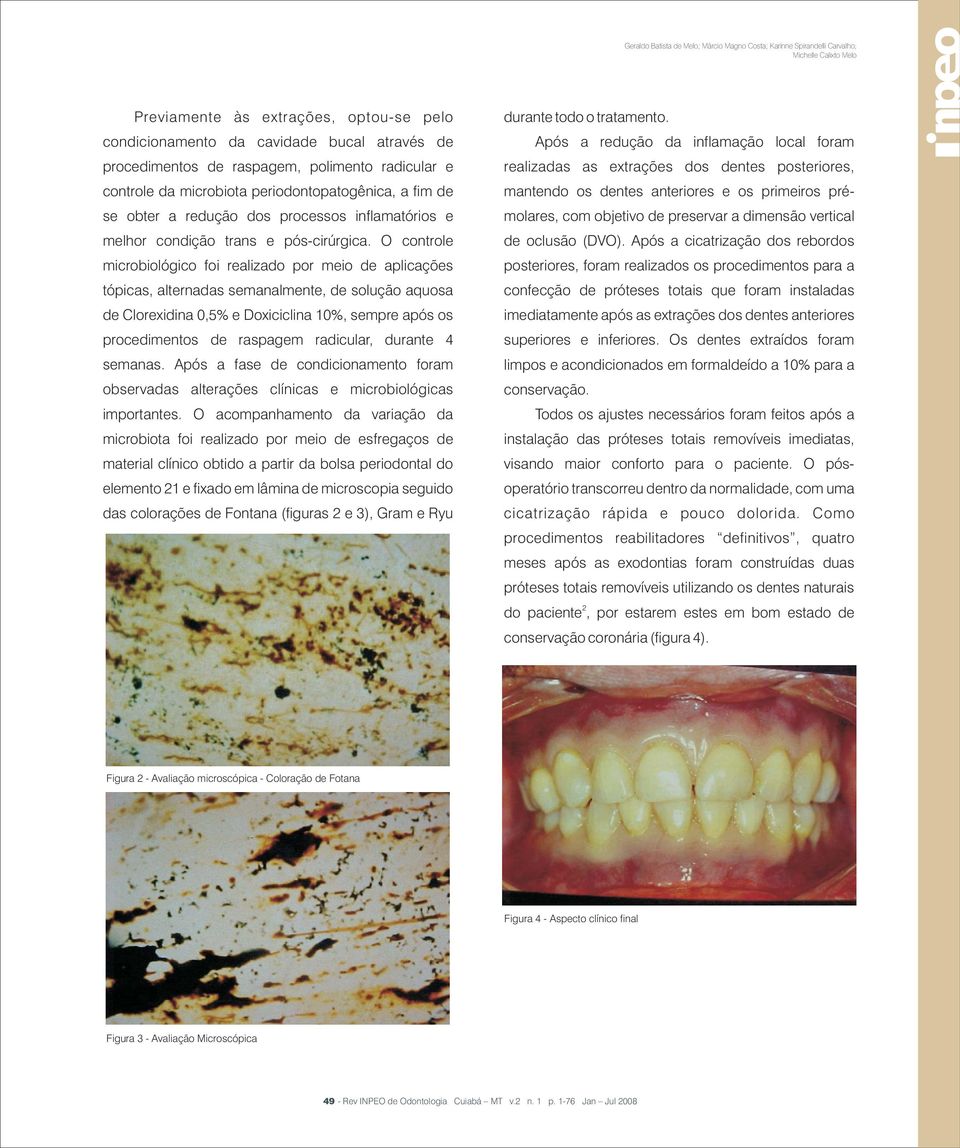 O controle microbiológico foi realizado por meio de aplicações tópicas, alternadas semanalmente, de solução aquosa de Clorexidina 0,5% e Doxiciclina 10%, sempre após os procedimentos de raspagem