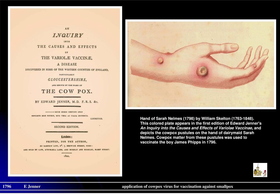 Effects of Variolae Vaccinae, and depicts the cowpox pustules on the hand of dairymaid Sarah Nelmes.