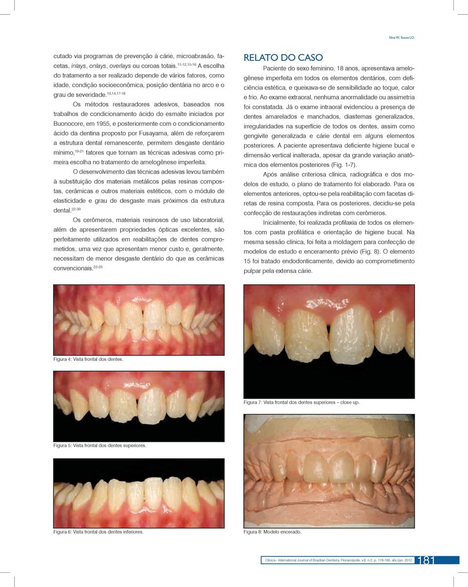 10,14,17-18 Os métodos restauradores adesivos, baseados nos trabalhos de condicionamento ácido do esmalte iniciados por Buonocore, em 1955, e posteriormente com o condicionamento ácido da dentina