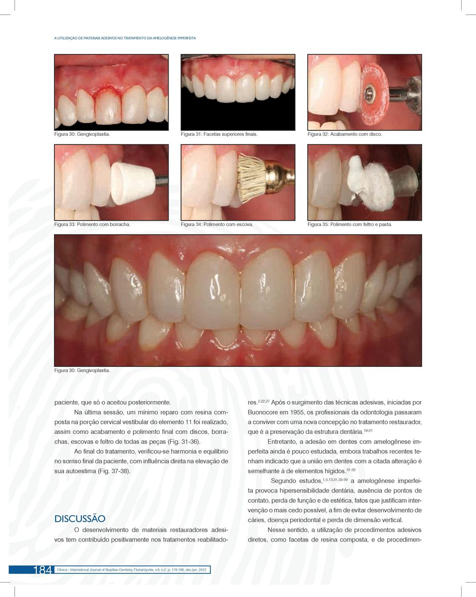 Na última sessão, um mínimo reparo com resina composta na porção cervical vestibular do elemento 11 foi realizado, assim como acabamento e polimento final com discos, borrachas, escovas e feltro de