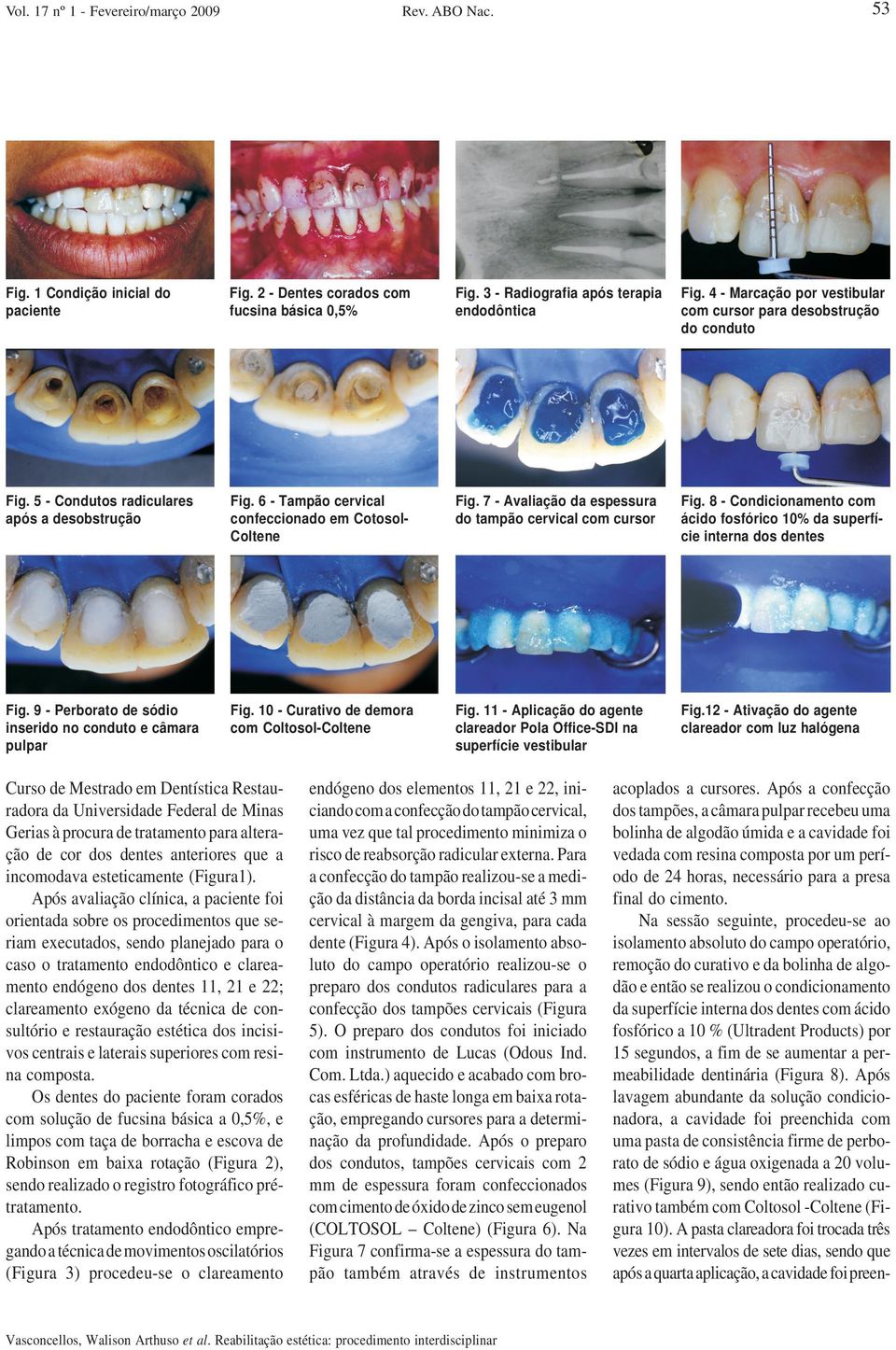 7 - Avaliação da espessura do tampão cervical com cursor Fig. 8 - Condicionamento com ácido fosfórico 10% da superfície interna dos dentes Fig.