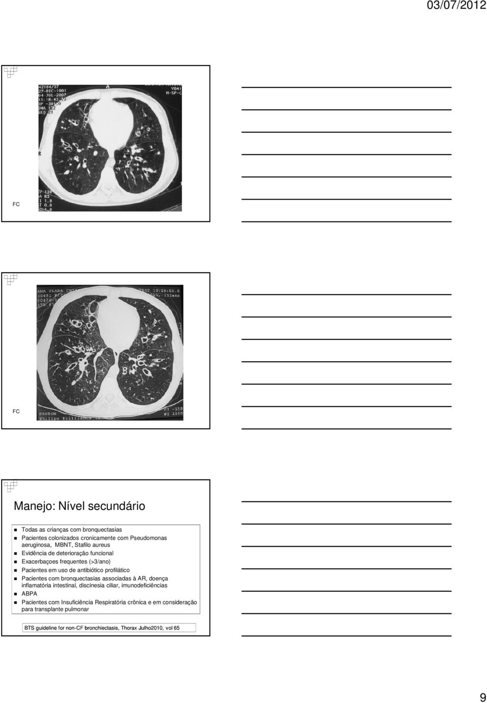 Pacientes com bronquectasias associadas à AR, doença inflamatória intestinal, discinesia ciliar, imunodeficiências ABPA Pacientes com