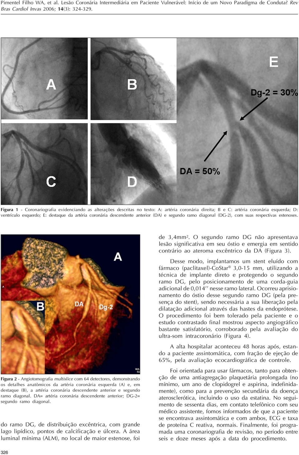 O segundo ramo DG não apresentava lesão significativa em seu óstio e emergia em sentido contrário ao ateroma excêntrico da DA (Figura 3).