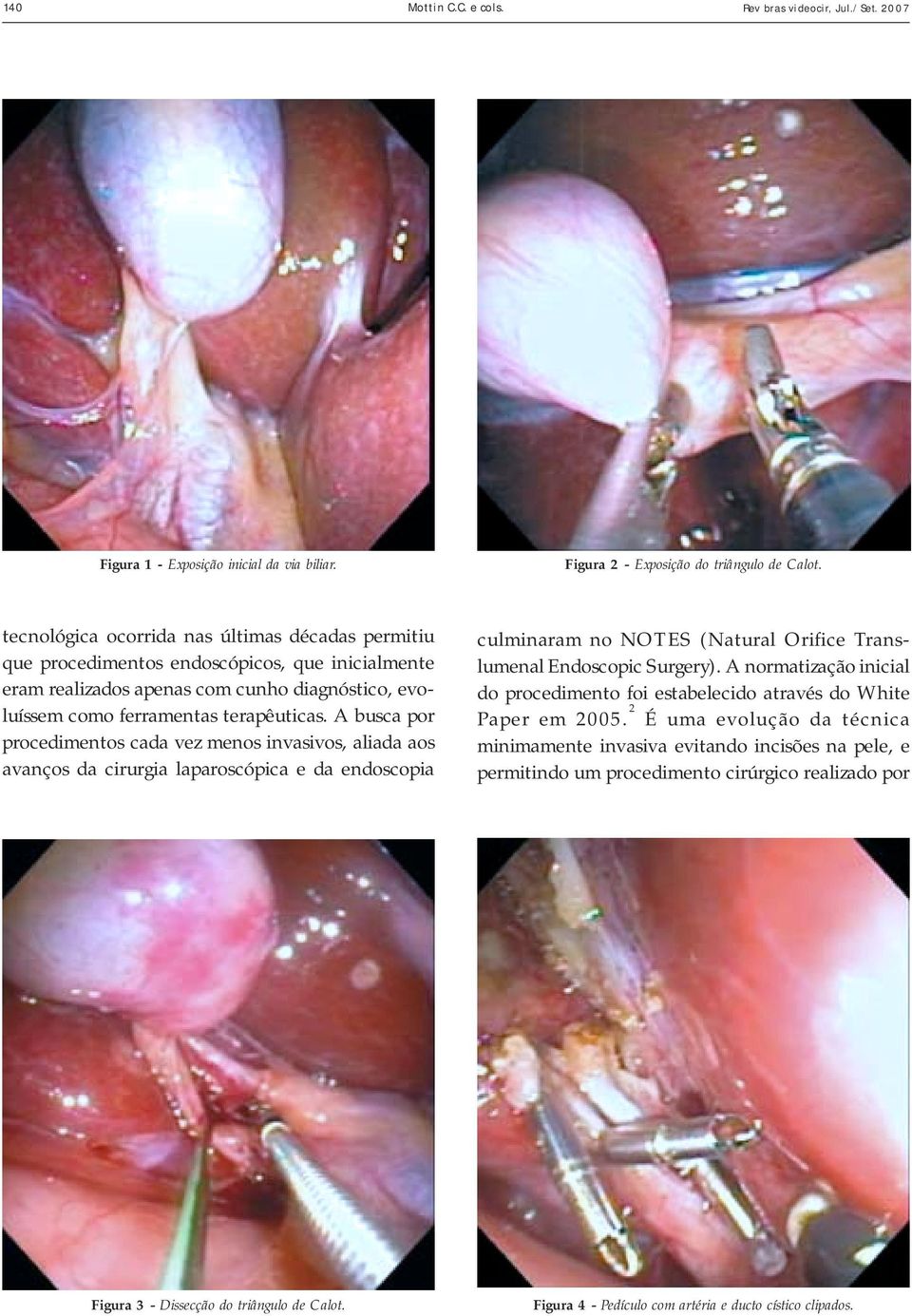 A busca por procedimentos cada vez menos invasivos, aliada aos avanços da cirurgia laparoscópica e da endoscopia culminaram no NOTES (Natural Orifice Translumenal Endoscopic Surgery).