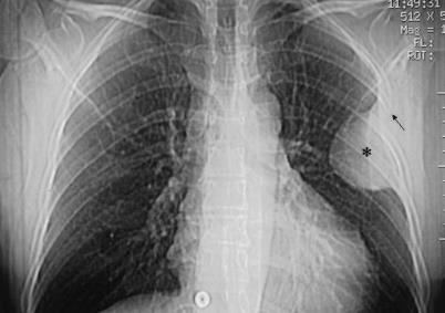 Plasmocitoma solitário Tumor ósseo