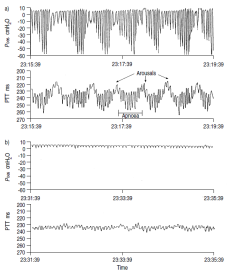 Tempo de trânsito de pulso RM50 (DeVilbiss, France) Smith R P et al. Thorax 1999;54:452-457 Noninvasive monitoring of respiratory mechanics during sleep R. Farre *, J.M. Montserrat, D.