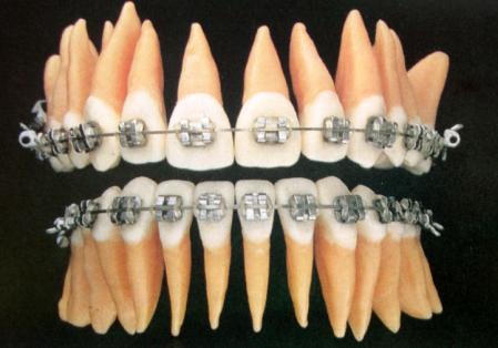 1. Introdução Com o surgimento dos acessórios pré-programados, a aplicação do torque passou a ser realizada de duas formas distintas: Pela torção do fio retangular em torno do longo eixo (técnica