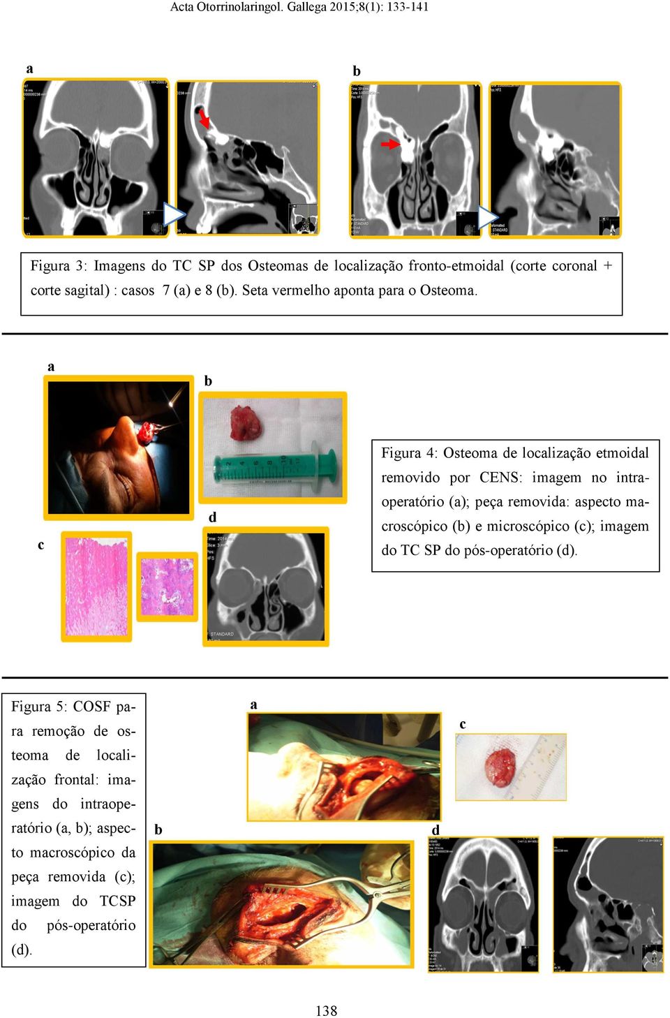 c d Figur 4: Osteom de loclizção etmoidl removido por : imgem no intropertório (); peç removid: specto mcroscópico () e