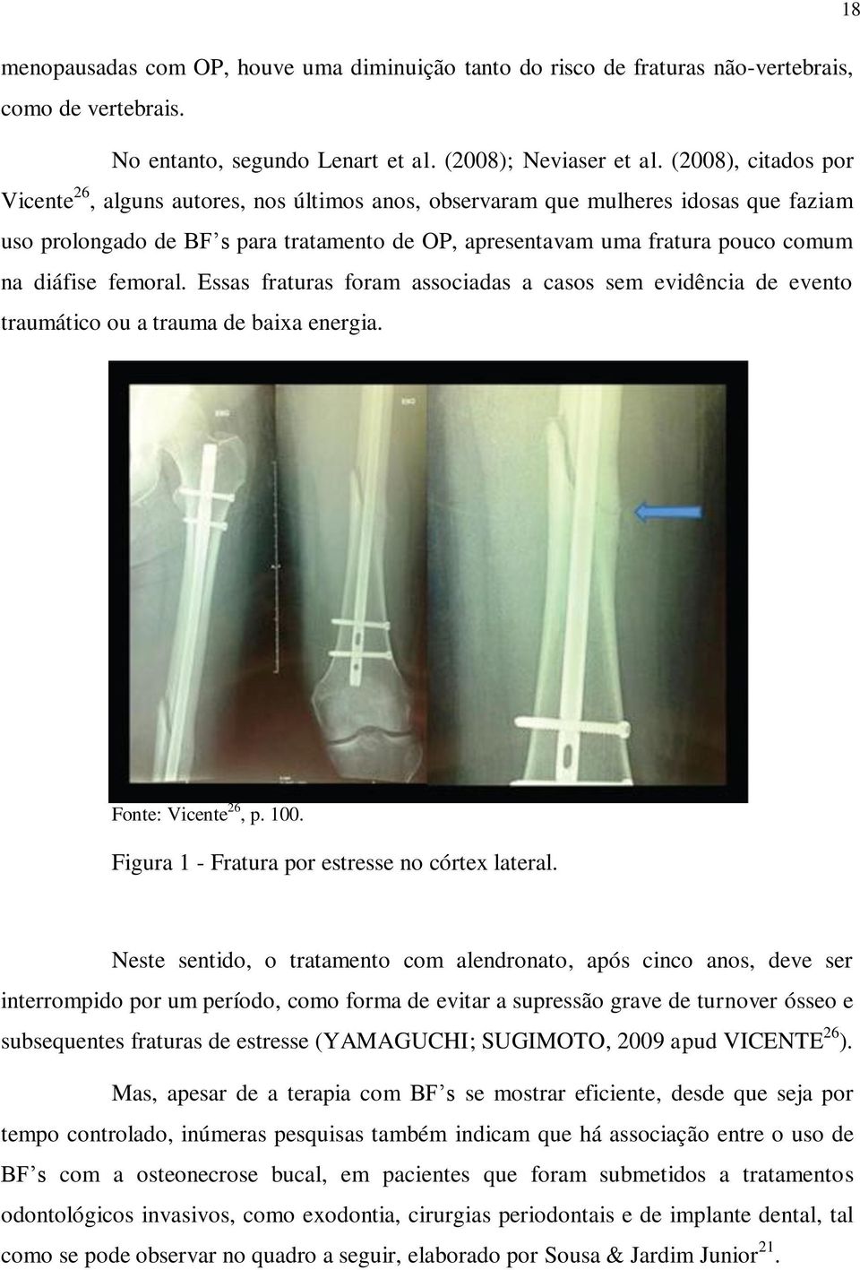 diáfise femoral. Essas fraturas foram associadas a casos sem evidência de evento traumático ou a trauma de baixa energia. Fonte: Vicente 26, p. 100. Figura 1 - Fratura por estresse no córtex lateral.