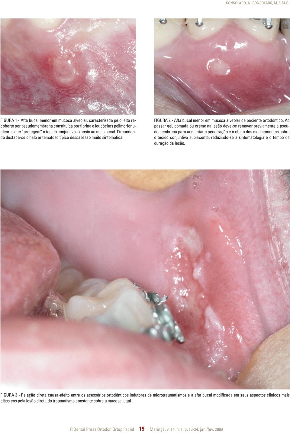 ao meio bucal. Circundando destaca-se o halo eritematoso típico dessa lesão muito sintomática. Figura 2 - Afta bucal menor em mucosa alveolar de paciente ortodôntico.