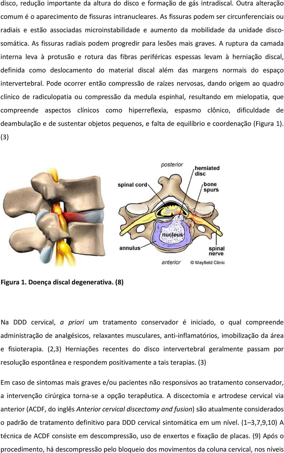 A ruptura da camada interna leva à protusão e rotura das fibras periféricas espessas levam à herniação discal, definida como deslocamento do material discal além das margens normais do espaço