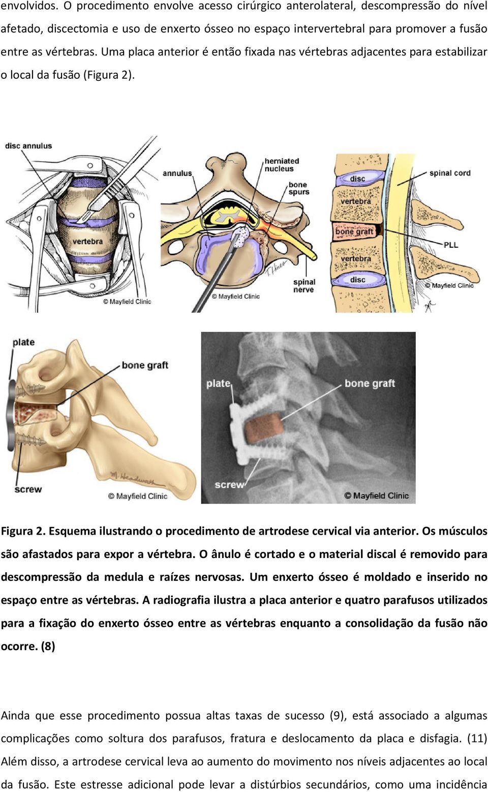 Os músculos são afastados para expor a vértebra. O ânulo é cortado e o material discal é removido para descompressão da medula e raízes nervosas.