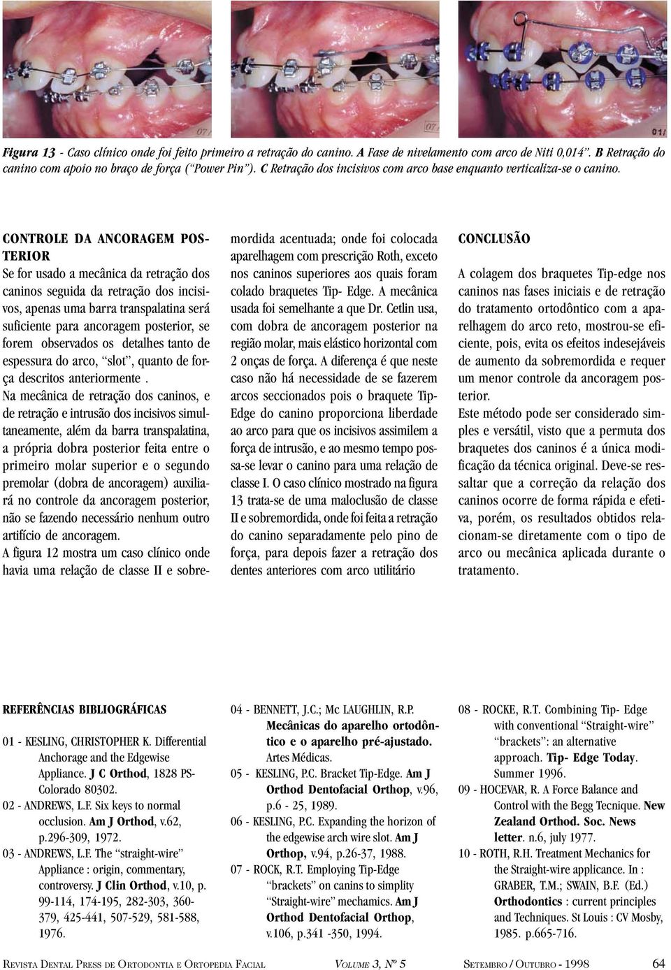 CONTROLE DA ANCORAGEM POS- TERIOR Se for usado a mecânica da retração dos caninos seguida da retração dos incisivos, apenas uma barra transpalatina será suficiente para ancoragem posterior, se forem