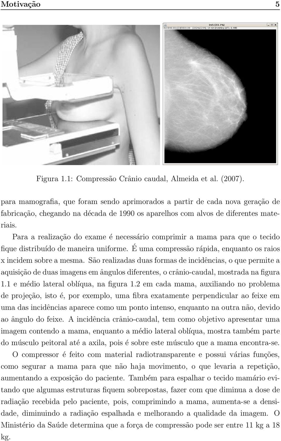 Para a realização do exame é necessário comprimir a mama para que o tecido fique distribuído de maneira uniforme. É uma compressão rápida, enquanto os raios x incidem sobre a mesma.