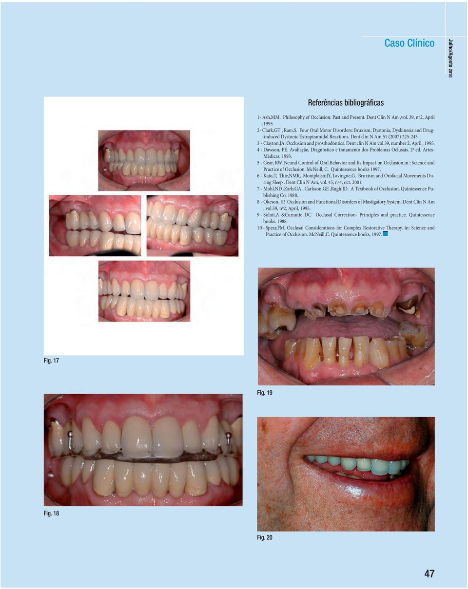 39, number 2, Aprl, 1995. 4 - Dawson, PE. Avalação, Dagnóstco e tratamento dos Problemas Oclusas. 2ª ed. Artes- Médcas. 1993. 5 - Gear, RW. Neural Control of Oral Behavor and Its Impact on Occluson.