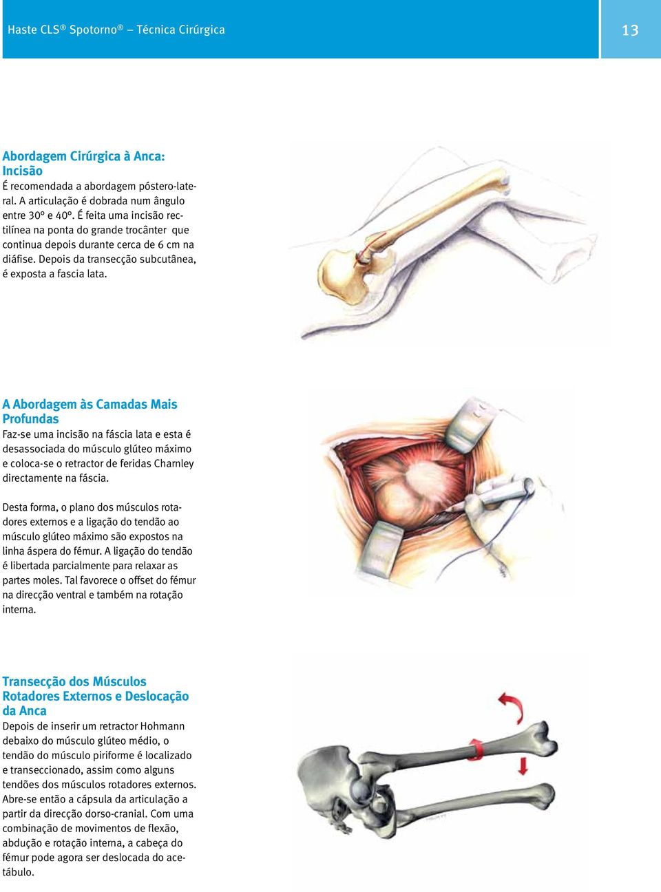 A Abordagem às Camadas Mais Profundas Faz-se uma incisão na fáscia lata e esta é desassociada do músculo glúteo máximo e coloca-se o retractor de feridas Charnley directamente na fáscia.