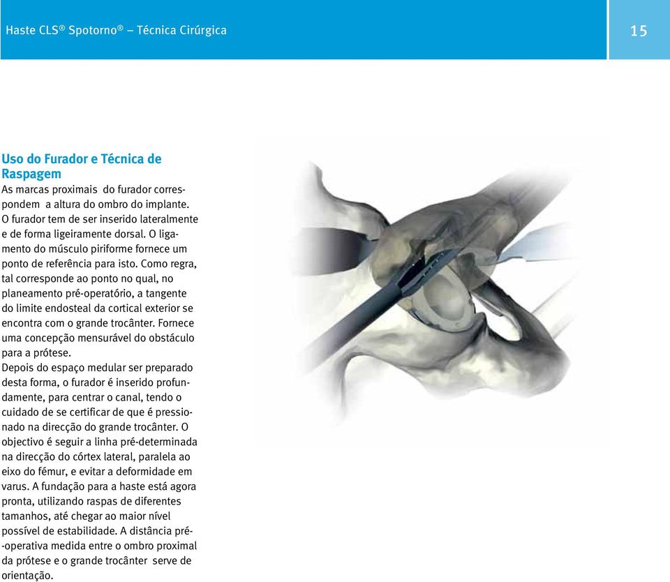 Como regra, tal corresponde ao ponto no qual, no planeamento pré-operatório, a tangente do limite endosteal da cortical exterior se encontra com o grande trocânter.