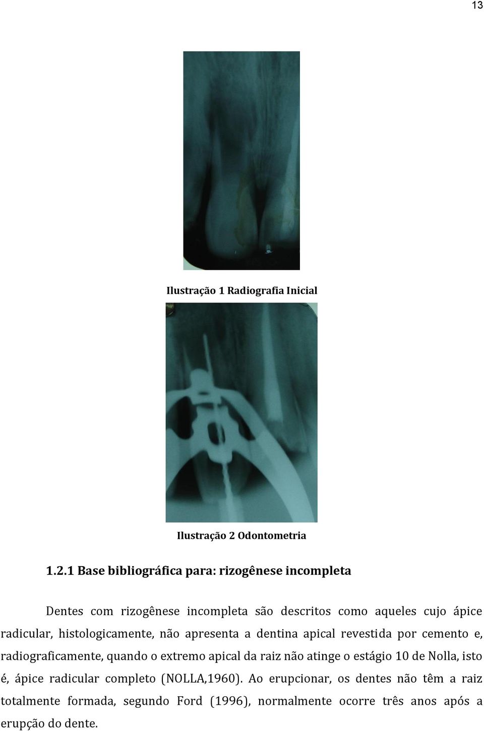 1 Base bibliográfica para: rizogênese incompleta Dentes com rizogênese incompleta são descritos como aqueles cujo ápice radicular,