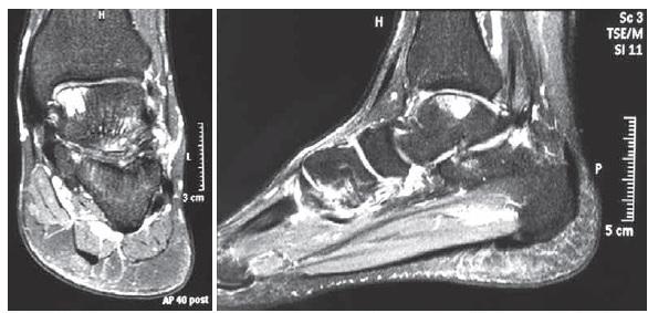 7 O exame físico revela equimose e edema em torno da articulação do tornozelo e não apenas na parte lateral do tornozelo [...] [.