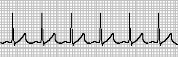 Ritmo Sinusal Diagnóstico Eletrocardiográfico Ondas P precedendo cada QRS Enlace A/V Ritmo regular (intervalos