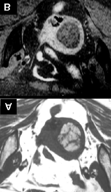Fig. 2 Lipoleiomioma intramural numa mulher de 63 anos. Imagens ponderadas em T1 axial (A) e T1 axial com supressão de gordura e após administração endovenosa de gadolíneo (B).