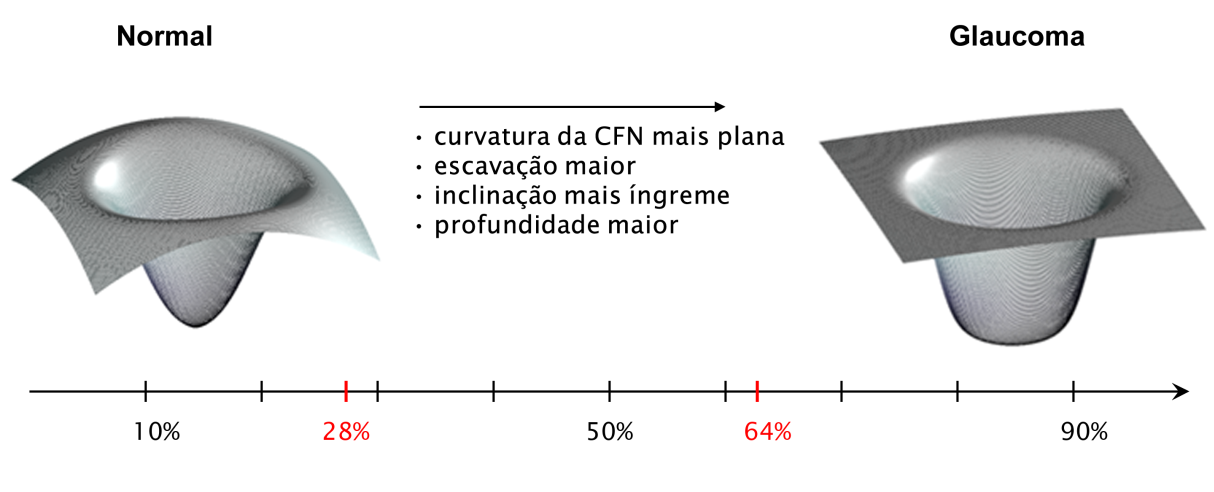 Revisão da literatura 19 Olhos com glaucoma costumam apresentar curvaturas da CFN menos acentuadas, tamanho e profundidade da escavação aumentados e aumento da inclinação da borda da rima (Figura 7).