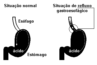 17 (MACKENZIE-SP) Certo informe publicitário alerta para o fato de que, se o indivíduo tem azia ou pirose com grande frequência, deve procurar um médico, pois pode estar ocorrendo refluxo