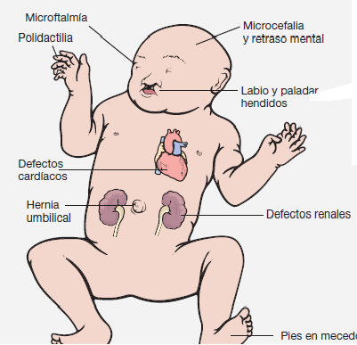 MICROCEFALIA NA ATENÇÃO BÁSICA Etiologias: Anomalias cromossômicas Sd Patau (T13) Sd Edwards