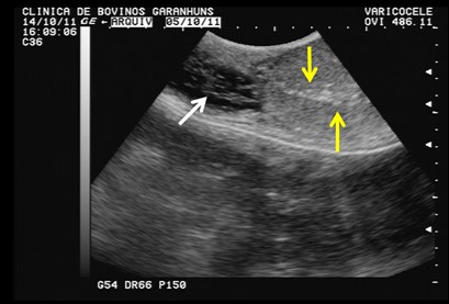 Fig. 2 Imagem ultrassonográfica longitudinal revelando cordão espermático dilatado com predomínio de áreas anaecoícas (Seta Branca) e parênquima testícular com pontos hiperecoícos sugerindo