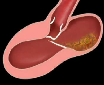 ABLAÇÃO SEPTAL NA CARDIOMIOPATIA