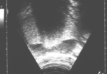 a) Fig. 3 - Ecotomografia transvaginal: lesão quística de conteúdo não puro, com nódulo hiperecogénico com atenuação posterior dos ultrasons, o qual corresponde à protuberância de Rokitansky (seta).