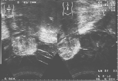 a) Fig. 8 - TC pélvica: Cistadenoma mucinoso associado a teratoma maduro (seta) do ovário direito. Fig. 7 - RM pélvica: teratoma maduro do ovário direito com pequena quantidade de gordura na parede do quisto.