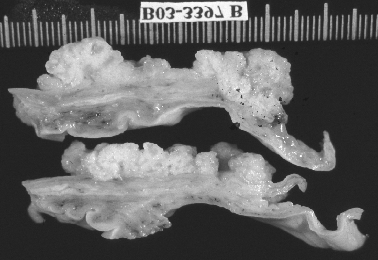 a) a) c) Fig. 11 - RM pélvica: Cistadenoma mucinoso gigante associado a teratoma maduro (seta horizontal) do ovário direito. a) ponderação em T1, corte axial.