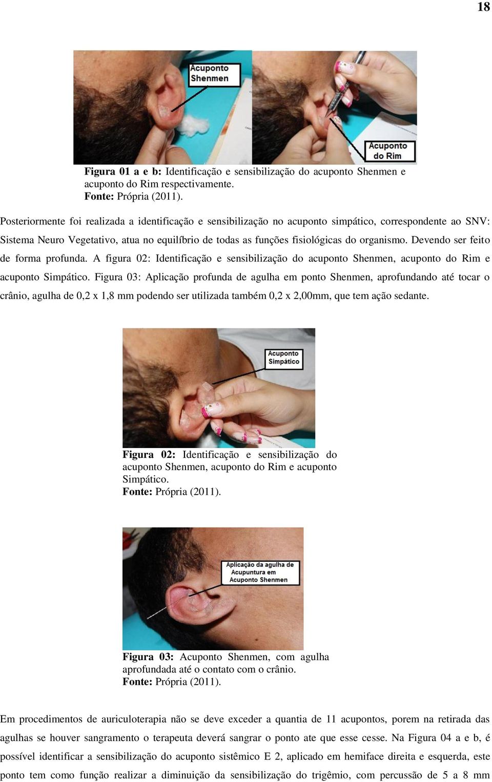 Devendo ser feito de forma profunda. A figura 02: Identificação e sensibilização do acuponto Shenmen, acuponto do Rim e acuponto Simpático.