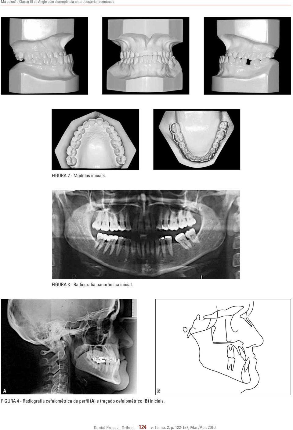 A B FIGURA 4 - Radiografia cefalométrica de perfil (A) e traçado