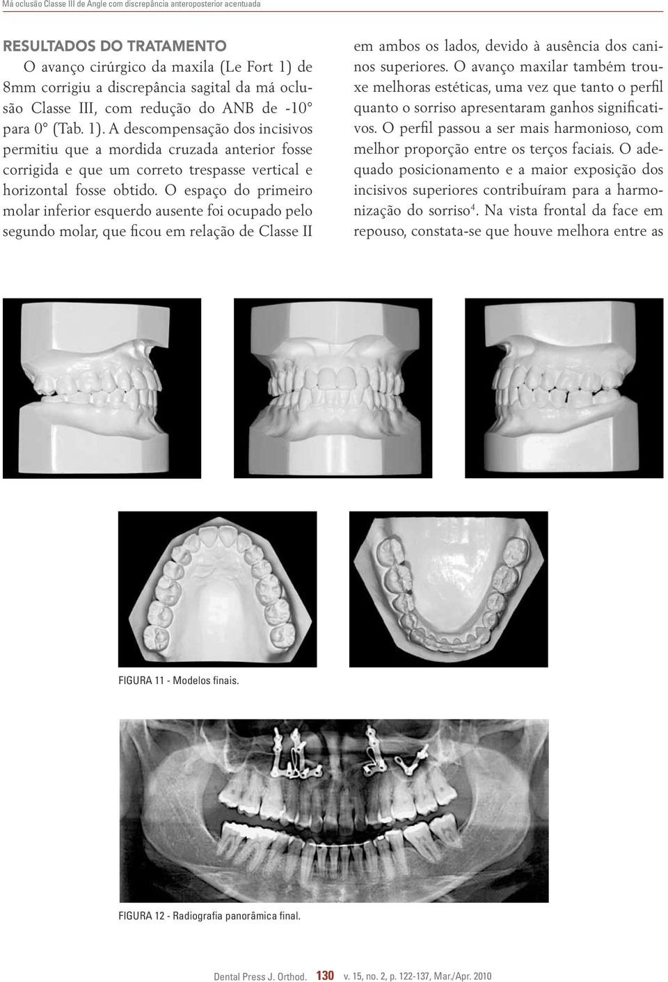 O espaço do primeiro molar inferior esquerdo ausente foi ocupado pelo segundo molar, que ficou em relação de Classe II em ambos os lados, devido à ausência dos caninos superiores.