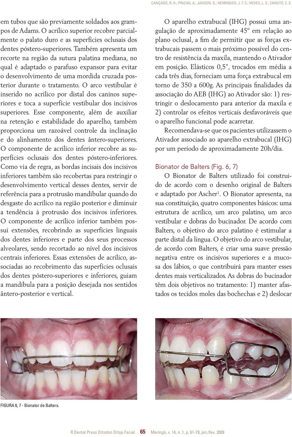 Também apresenta um recorte na região da sutura palatina mediana, no qual é adaptado o parafuso expansor para evitar o desenvolvimento de uma mordida cruzada posterior durante o tratamento.