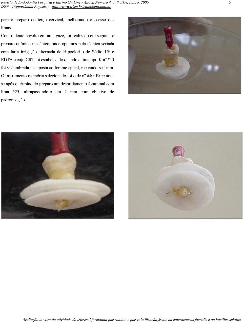 Hipoclorito de Sódio 1% e EDTA e cujo CRT foi estabelecido quando a lima tipo K nº #10 foi vislumbrada justaposta ao forame apical, recuando-se 1mm.