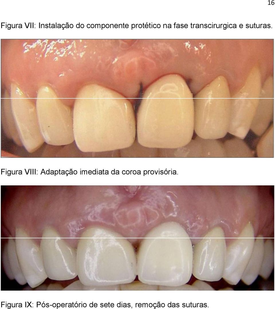 Figura VIII: Adaptação imediata da coroa