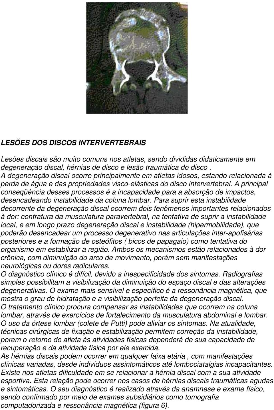 A principal conseqüência desses processos é a incapacidade para a absorção de impactos, desencadeando instabilidade da coluna lombar.