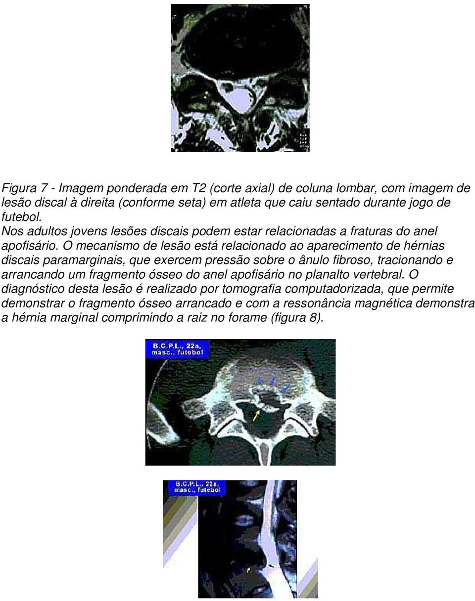 O mecanismo de lesão está relacionado ao aparecimento de hérnias discais paramarginais, que exercem pressão sobre o ânulo fibroso, tracionando e arrancando um fragmento ósseo